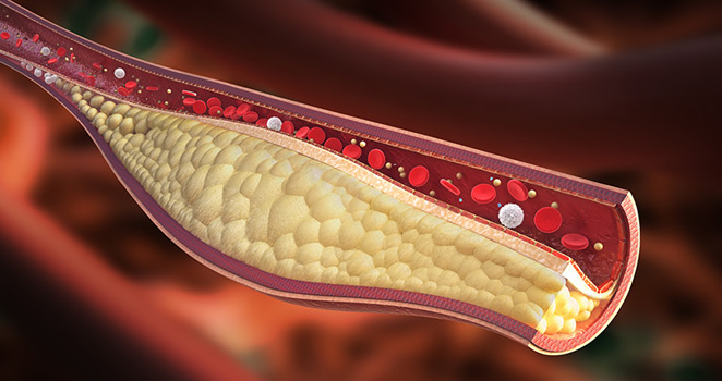 Illustration of a clogged artery