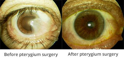 Berfore and after pterygium surgery