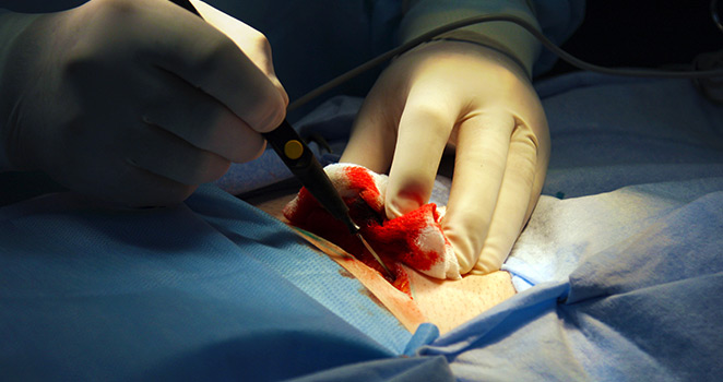 Carotid Endarterectomy surgery in progress