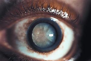 Close up of an eye with a cataract