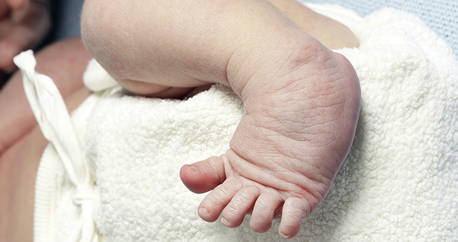 Baby's foot with a club deformity 
