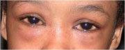 Young girl with conjunctivitis