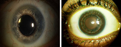 Close up of a before and after of a cornea transplant