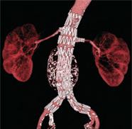 illustration of an Endovascular Abdominal Aortic Aneurysm 