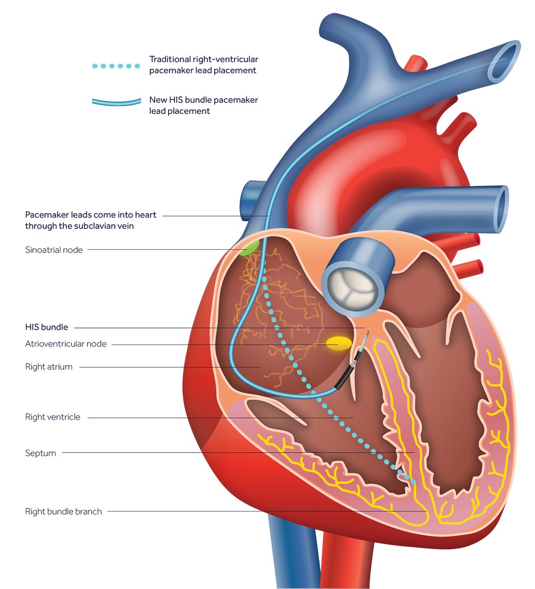 Illustrated diagram of a heart with a pacemaker inserted