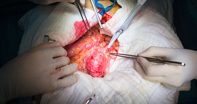 Open Abdominal Aortic Aneurysm Repair surgery in progress