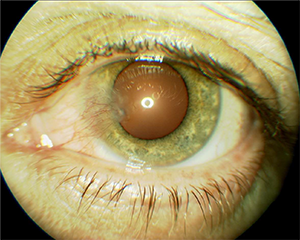 Close up of and eye with Pterygium