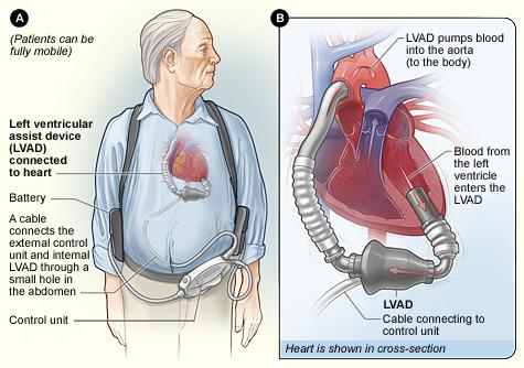 What is a VAD?